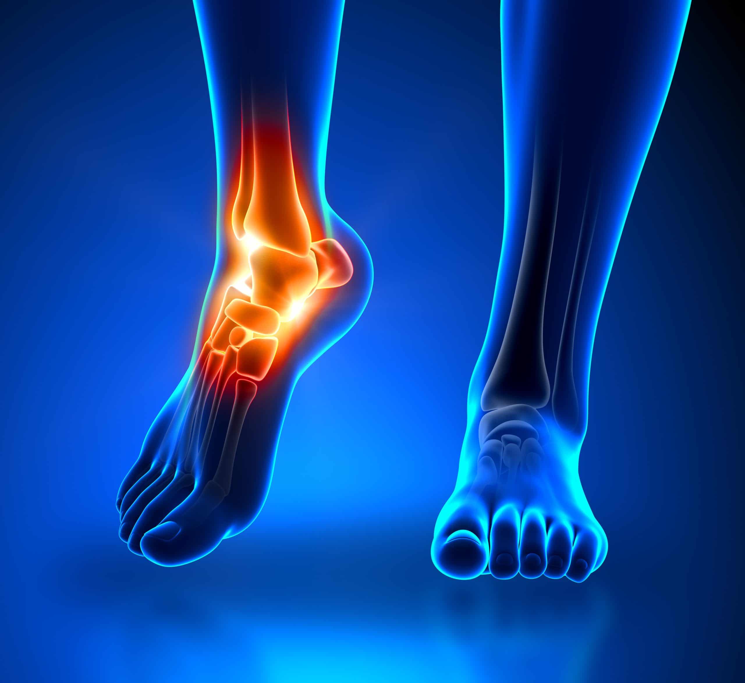Ankle Pain